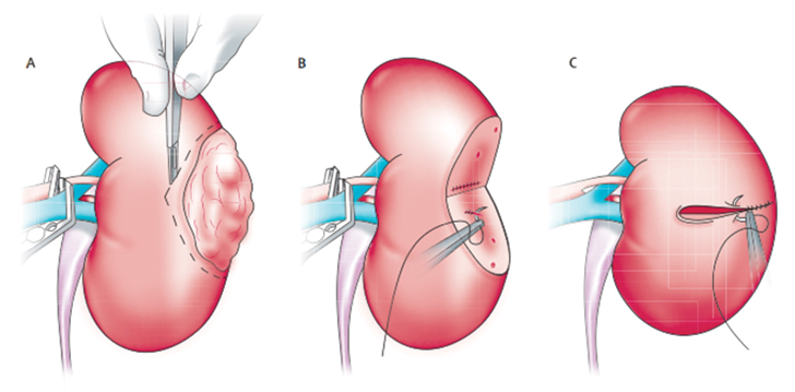 Figure 2. Partial Nephrectomy Surgical Technique in a Patient with Localized Kidney Cancer.